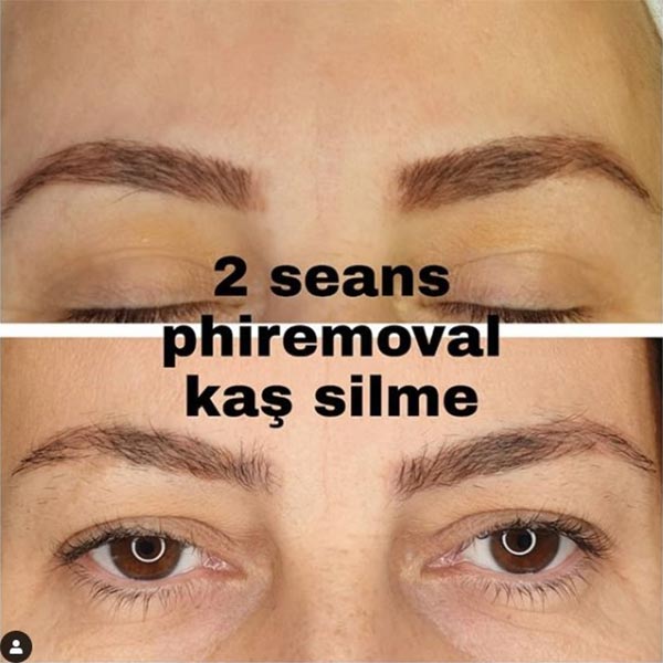 Kalıcı makyaj silme -  Phiremoval