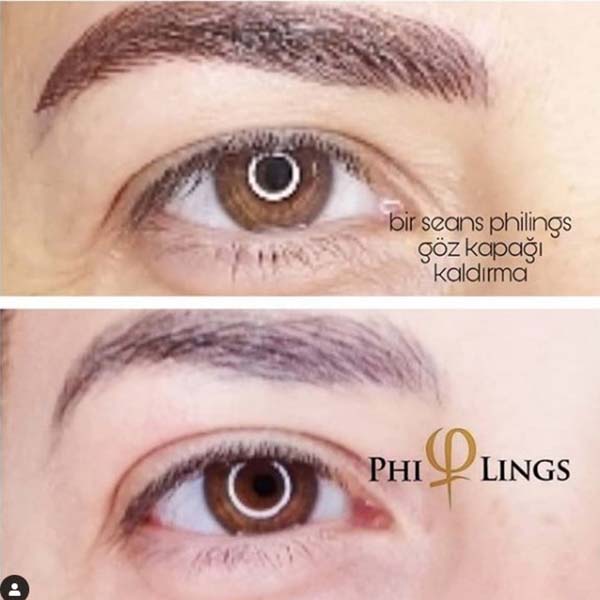 PhiLings (Cilt Gençleştirme,  Cilt lekeleri, Akne izleri, Cilt toparlama.)